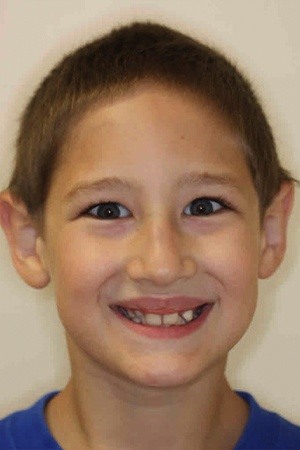 Young boy with misaligned teeth before braces