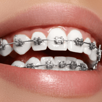 Closeup of smile with self ligating bracket and wire braces