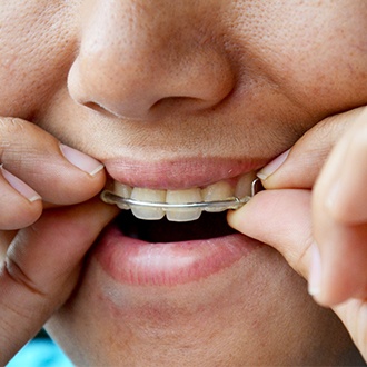 Closeup of patient placing orthodontic appliance