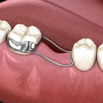 orthodontic maintainer grafton