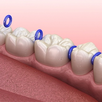 Animated smile with tooth spacers